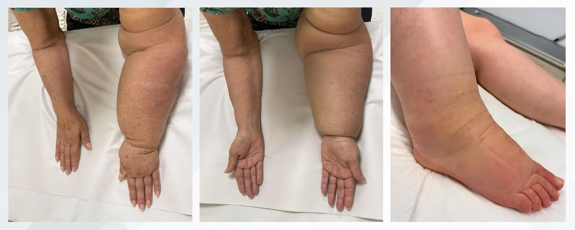 Linfedema en extremidades superiores e inferiores — presentación clínica