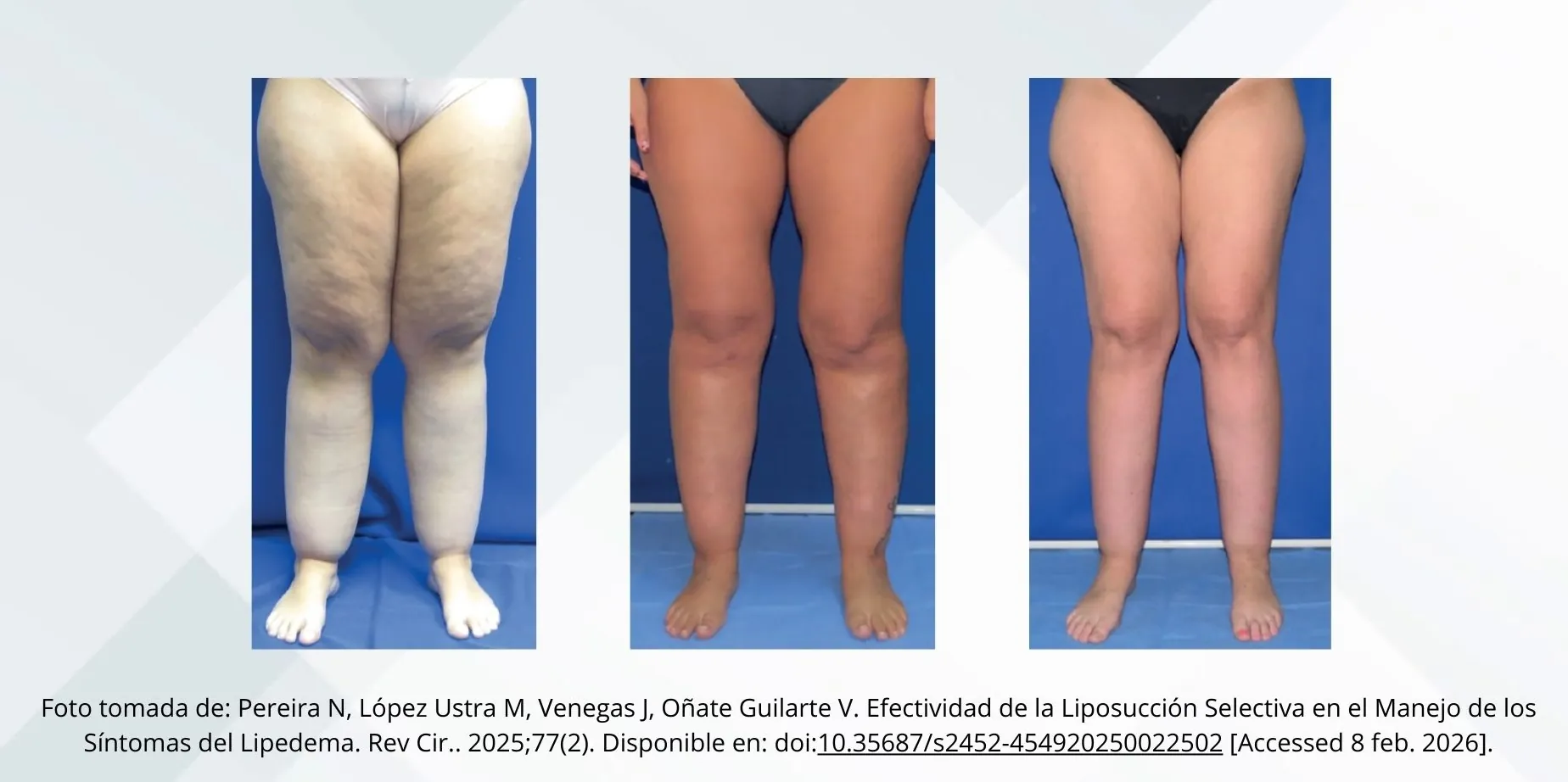 Resultados de liposucción selectiva en lipedema — antes y después del tratamiento